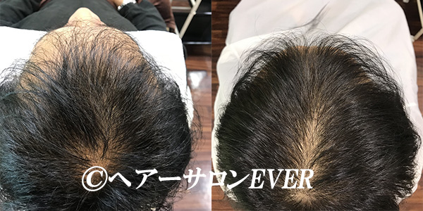 男性の増毛の施術例 千葉駅 千葉市中央区で理容室を選ぶならヘアーサロンever